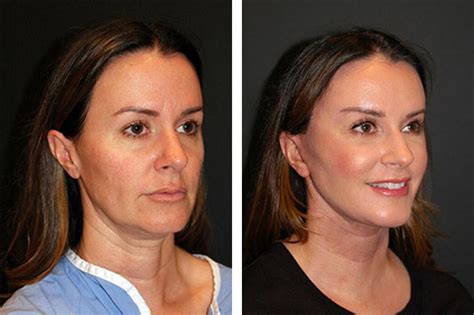 This nonsurgical procedure passes threads under the surface of your skin and pulls them taut to lift sagging in your face or neck. Facelift in Your Forties | What is Best Age for Facelift