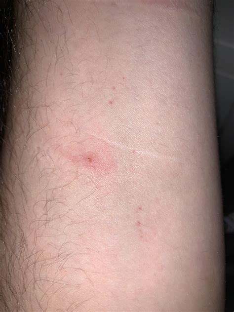 What Are These Marks The One With The Scab And Redness Is Extremely
