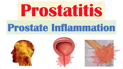 Prostatitis Prostate Inflammation Different Types Causes Signs Symptoms Diagnosis