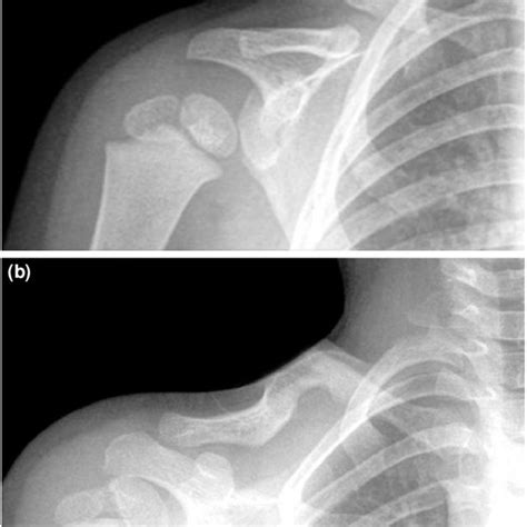 Clinical Aspect Of Congenital Pseudarthrosis Of The Clavicle