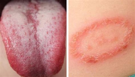 Candidiasis Qu Es S Ntomas Y Tratamiento