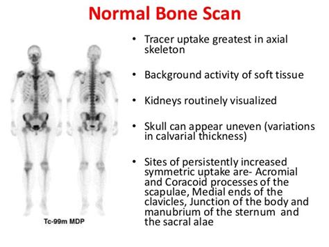 Bone Scan In Orthopaedics