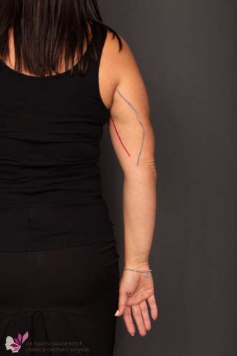 Brachioplasty Arm Reduction Scars Dr Gavin Sandercoe