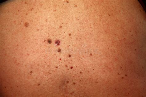 Skin Rash Skin Cancer Skin Wart Stock Image Image Of Concern Cancer