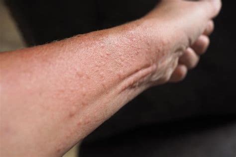 Eczema And Dermatitis Mona Dermatology