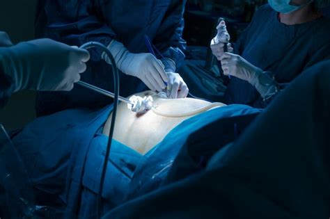 Bariatric Surgery Reduces Cancer Risk In Patients With Nonalcoholic