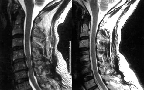 Abnormal Cervical Spine Mri