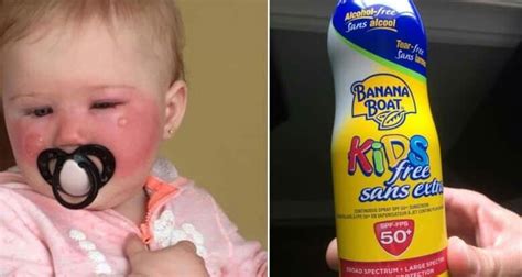 External Tens Allergic Reaction From Banana Boat Sunscreen Sjs