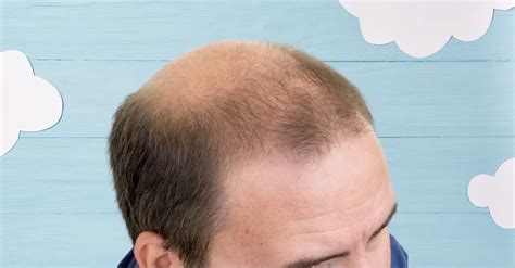 Balding At The Crown Causes Signs And Treatments Stages Of Balding
