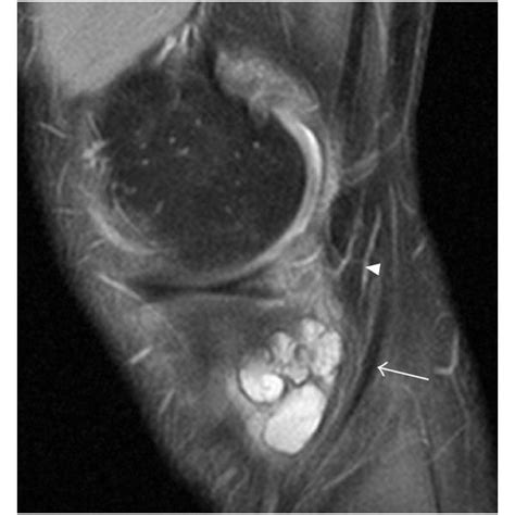 Synovial Recess Along The Popliteus Tendon Presented At Three Distances