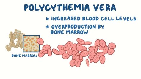 Polycythemia Vera Symptoms Causes Risk Factors And Complications