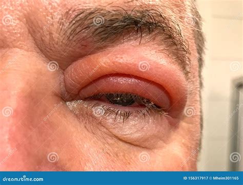 Detail Of Badly Swollen Upper Eyelid Of A Man Stock Image Image Of
