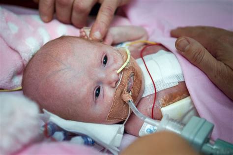 Vanellope Baby Born With Heart Outside Her Body Survives Rare