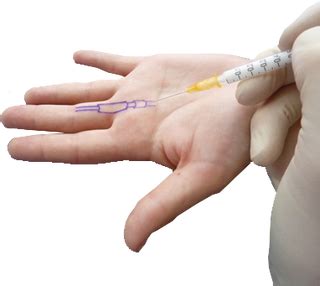 Doctors can use cortisone injections by themselves to treat certain diseases, disorders or conditions. Trigger Finger - Atlanta Bone and Joint Specialists