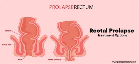 Guide To Evaluate And Test Rectal Prolapse What You Should Know