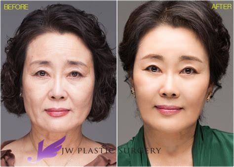 JW Plastic Surgery Korea Face Lifting Endo Forehead Lifting Fat