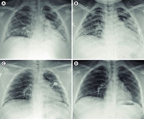 Serial Chest Radiographs A Hd 1 Chest Pa On January 3 2022 Showed