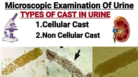 Cast In Urine Microscopic Examination Of Urine Types Of Cast In
