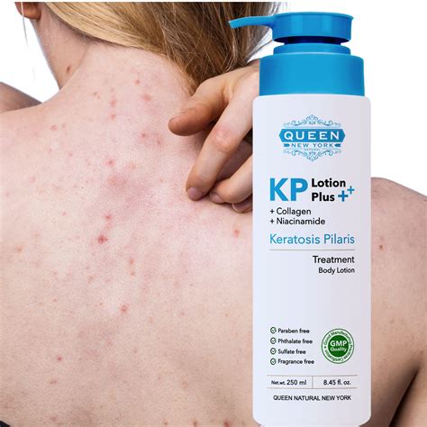 Buy Queen Kp Plus Keratosis Pilaris Exfoliating Body Lotion Collagen