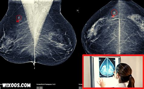 Artificial Intelligence In Mammography Breast Cancer Detection