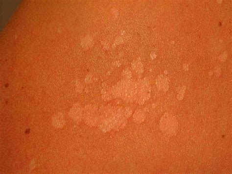 Tinea Versicolor Causes Diagnosis And Treatment