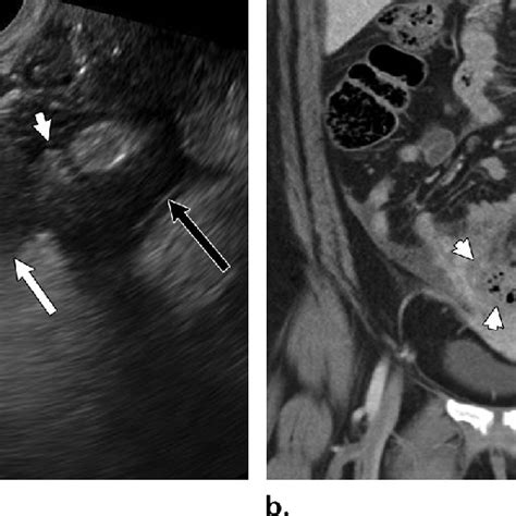 Rectal Duplication Cyst In A 43 Year Old Woman Who Presented With Download High Resolution