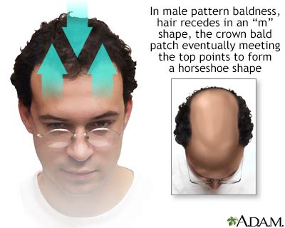 HIE Multimedia Male Pattern Baldness
