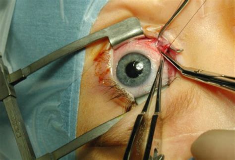 That is because, the body is still changing and even the eyes are still trying to get their correct places; Curar las cataratas, operaciones rápidas y eficaces cuando ...