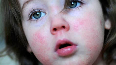 British Doctors Warned Of A Flash Of Scarlet Fever Earth Chronicles News