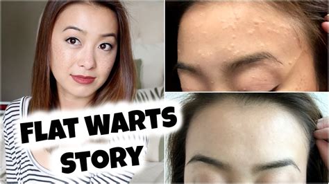My Flat Warts Story Spontaneous Regression With Pictures Youtube