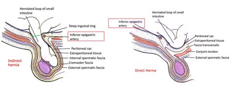 Inguinal Hernias Direct And Indirect Inguinal Hernias Differences