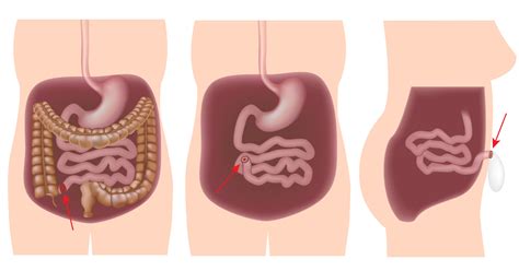 We did not find results for: Pan-proctocolectomy with ileostomy surgery | IBDrelief