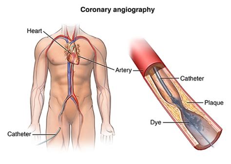 cardiac catheterization johns hopkins medicine