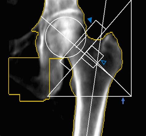 Bmd Was Measured With Dxa In The Contralateral Hip Roi For The Femoral