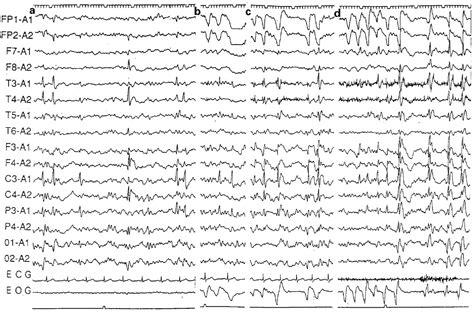 Blink Induced Centrotemporal Spikes In Benign Childhood Epilepsy With