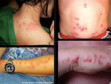 Bed Bug Bite Symptoms Pictures Causes And Treatment