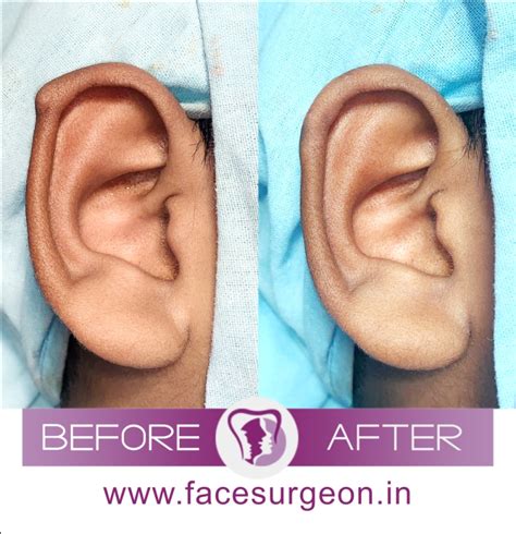 Otoplasty Know About The Best Cosmetic Ear Surgery In India