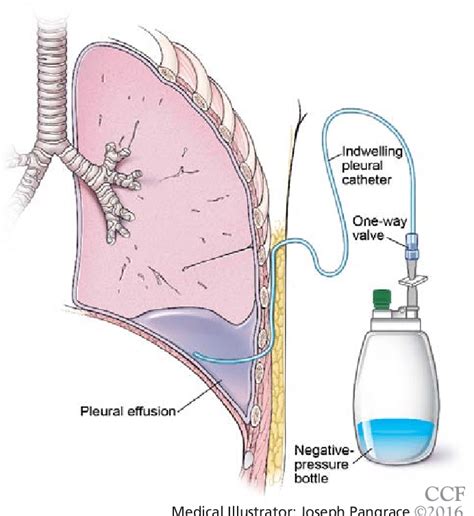 Pleural Catheter