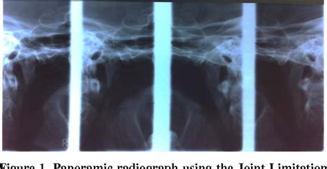 Figure From Rheumatoid Arthritis Of The Temporomandibular Joint Comparison Of Digital