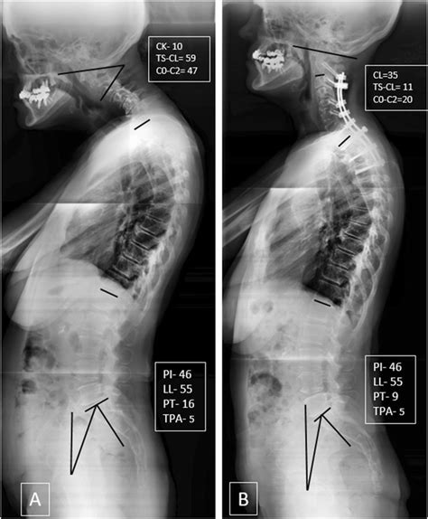 Pre And Post Operative Cervical Radiographs Of A Patient With Cervical