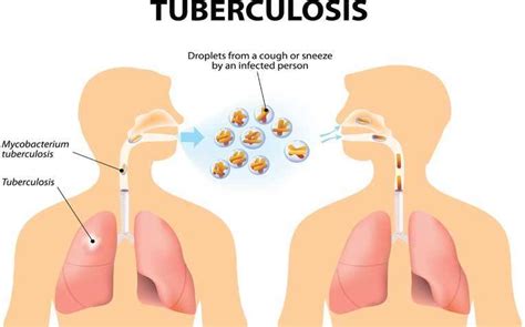 A type of bacteria called mycobacterium tuberculosis. Hospital starts treating TB patients using modern ...