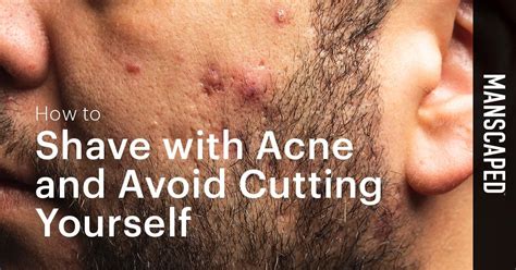 How To Shave With Acne And Avoid Cutting Yourself Manscaped