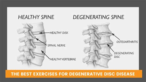 The Best Exercises For Degenerative Disc Disease Solving Pain With