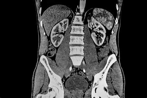 Abdominal Ct Scan What Testing Shows