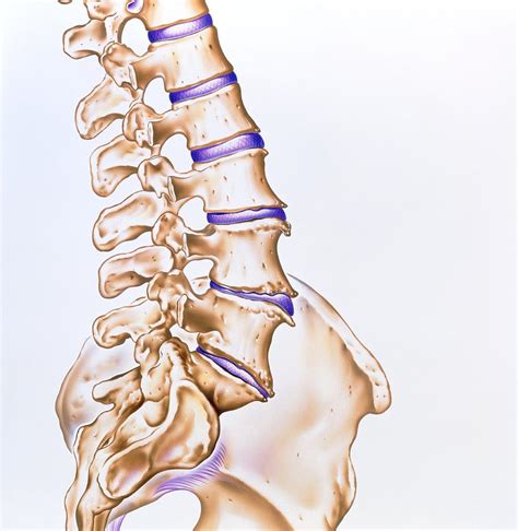 Artwork Of Osteoarthritis Of The Spine Photograph By John Bavosi Fine