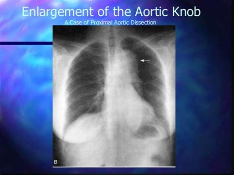 Aortic Dissection Drtapu