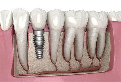 Implanturile Dentare Tot Ce Trebuie S Tim Despre Implanturi I Procedura De Inserare Implant