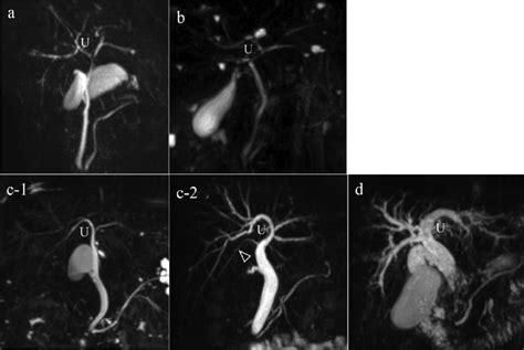 Typical Mrcp Images Of The Intrahepatic Bile Ducts Of Rslt Livers A