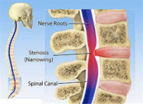 Lower Back Pain Is It Hip Arthritis Or Lumbar Spinal Stenosis The