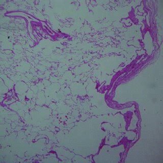 Most people who undergo lung transplantation for lung parenchyma make great strides in their quality of life and. (A) Lung perfusion scintigram. Lack of accumulation in the ...